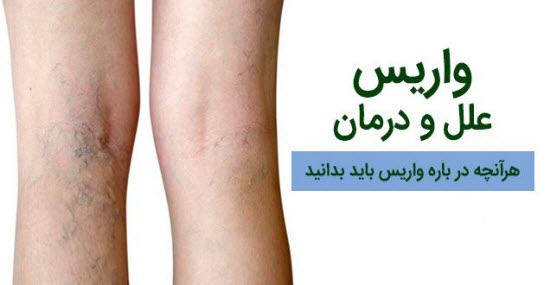 واریس ، علل و روش های درمان
