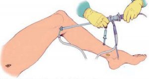 جراحی آندوسکوپی واریس
