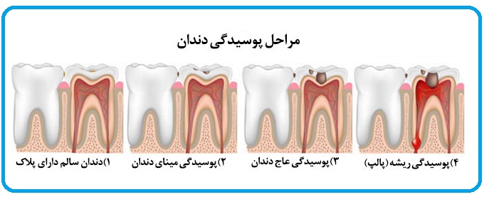 از پوسیدگی دندانهایتان جلوگیری کنید