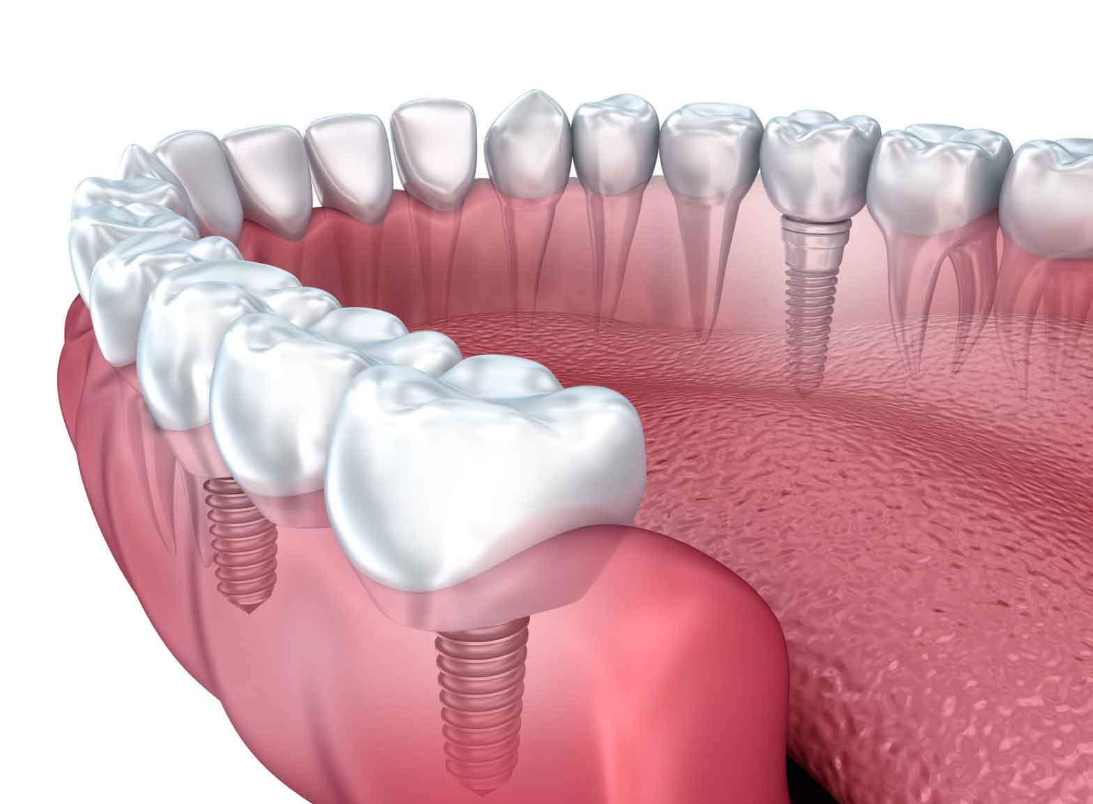 Dental_implant_specialist.jpg