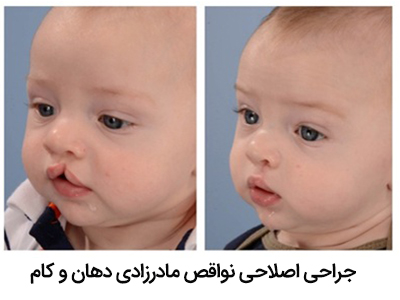 جراحی اصلاحی نواقص مادرزادی دهان وکام
