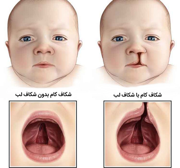 شکاف کام یا لب شکری